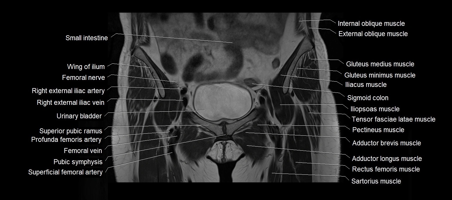 MRI 3T pelvis coronal cross section anatomy image 7.webp